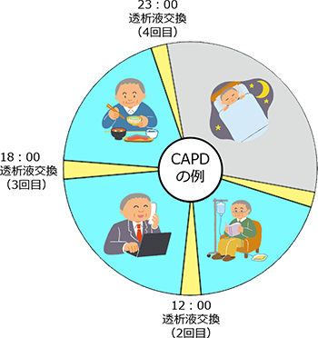 図3 CAPDの治療パターン例