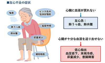 左心不全の症状