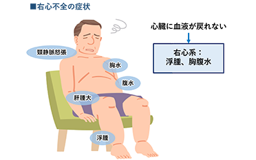 右心不全の症状