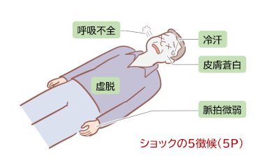 ショックの5徴候（5P）