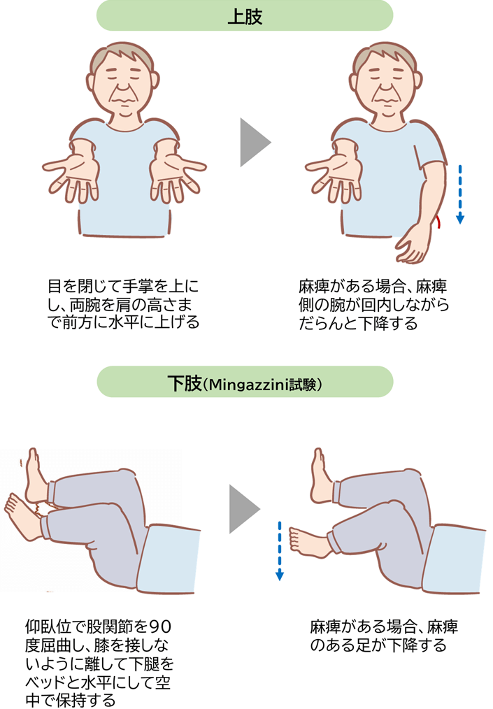 バレー徴候