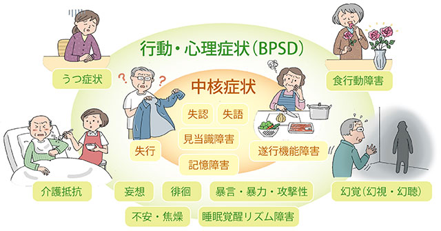 アルツハイマー 型 認知 症