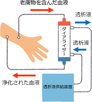 図1 血液透析のしくみ