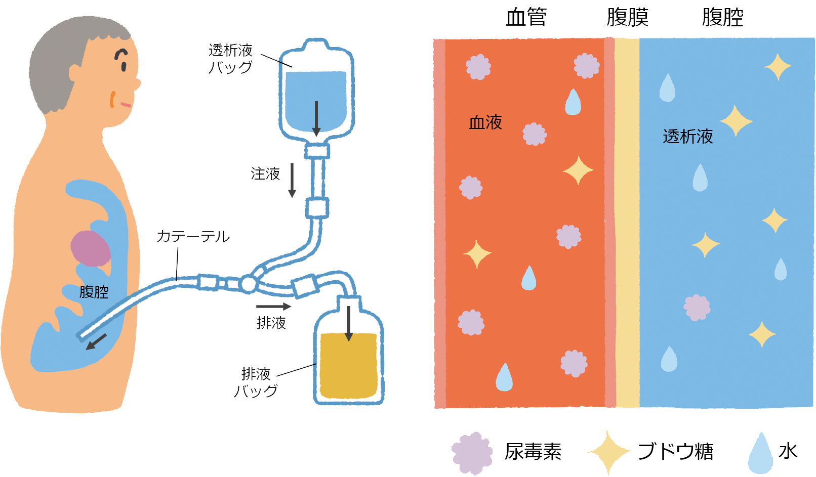 図1　腹膜透析のしくみ