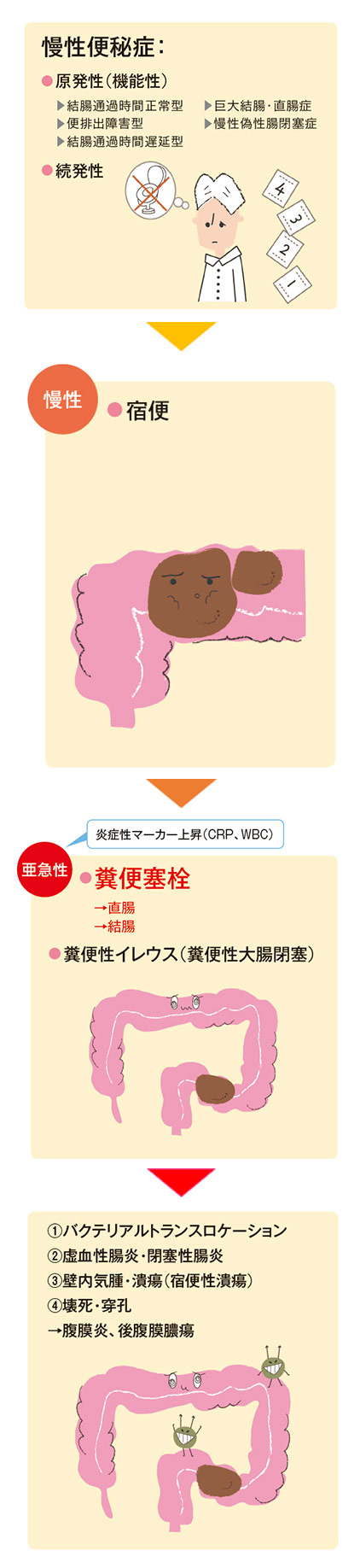 図1　宿便から糞便塞栓への進展