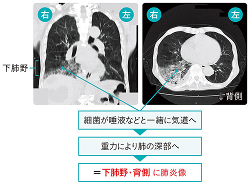 図1　CT画像（誤嚥性肺炎）（イメージ）
