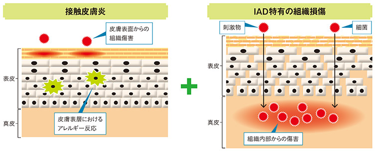 図3　IADの発生メカニズム（イメージ）