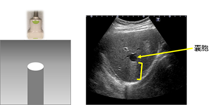 図5　後方エコー増強