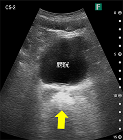 写真1　経腹アプローチ走査法：半月型便