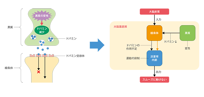 図1 ドパミンの減少と運動障害