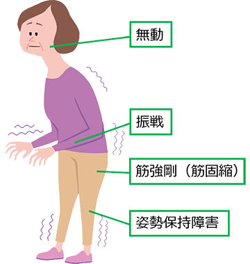 図1 パーキンソン病の四大症状