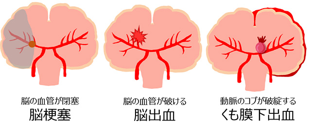 脳卒中とは