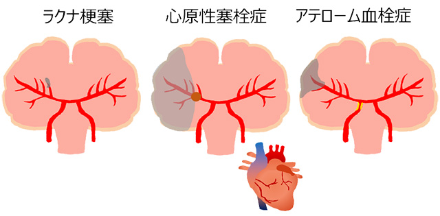 脳梗塞の病型