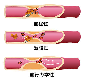 脳梗塞の発生機序