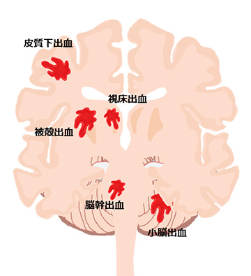 脳出血の好発部位