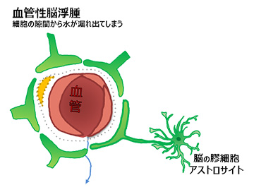 血管性脳浮腫のイメージ