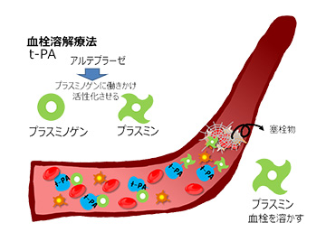 血栓溶解療法の機序