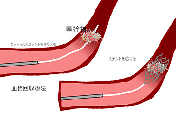 血栓回収療法のイメージ