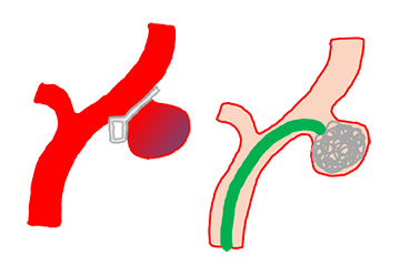 動脈瘤のクリッピング術とコイル塞栓術