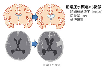 正常圧水頭症（右）