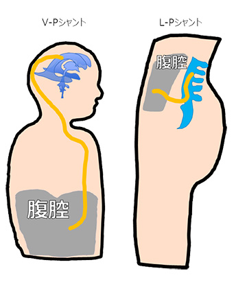 シャント術