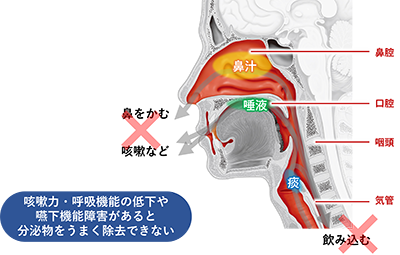 図2　喀出不全による分泌物の貯留
