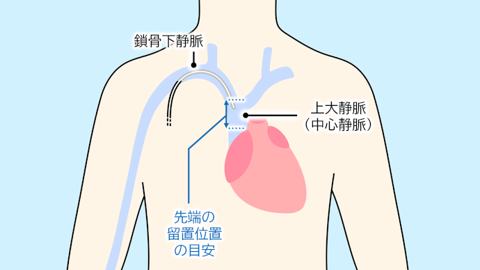 TPNのカテーテル先端留置位置