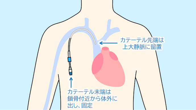 体外式カテーテルの留置イメージ
