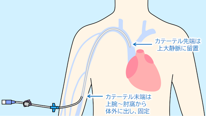 末梢挿入型中心静脈カテーテル（PICC）の留置イメージ