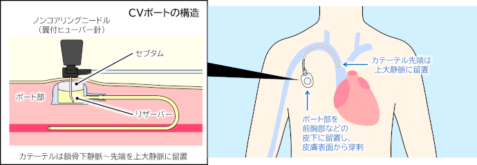 CVポートの留置イメージ