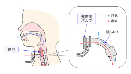 図8　発声可能な気管カニューレの発声方法と原理