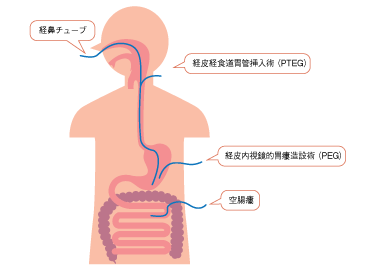 図1　経腸栄養の主な投与ルートの参照画像