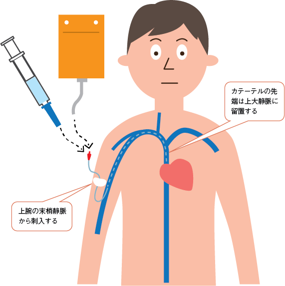 図1　PICCの参照画像