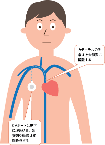 図2　CVポートの参照画像