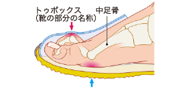 図3 クロウトゥ変形に伴うさらなる創傷リスク