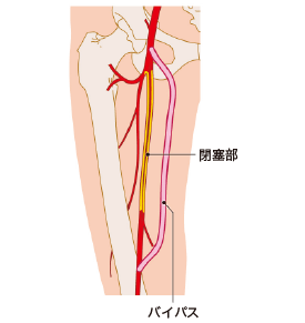 図2　バイパス術