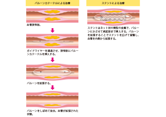 図3　血管内治療