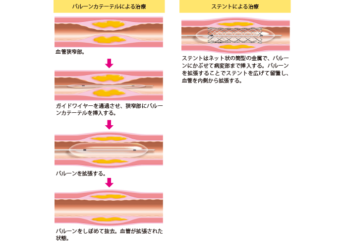 図3 血管内治療