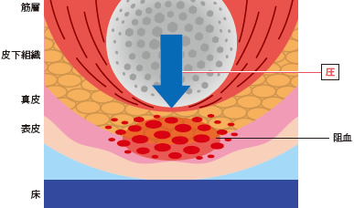 図２ 局所における褥瘡発生の機序