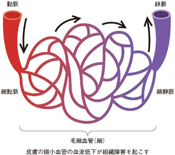 図５ 阻血性障害のメカニズム