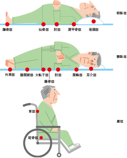 図１ 褥瘡の好発部位