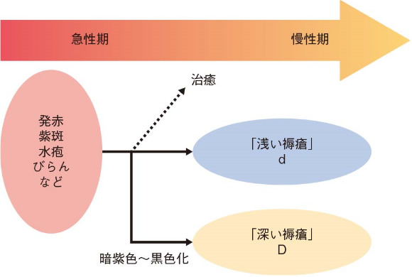 図１ 褥瘡の進展様式