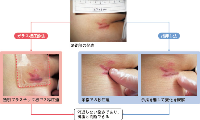 図１ 発赤の見きわめ方法（指押し法とガラス板圧診法）