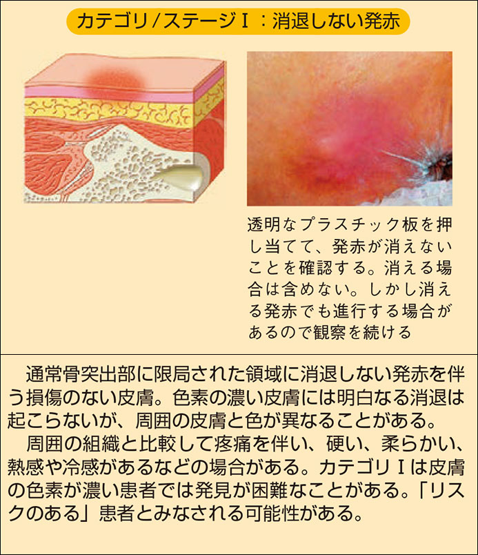 真皮 を 越える 褥瘡 と は