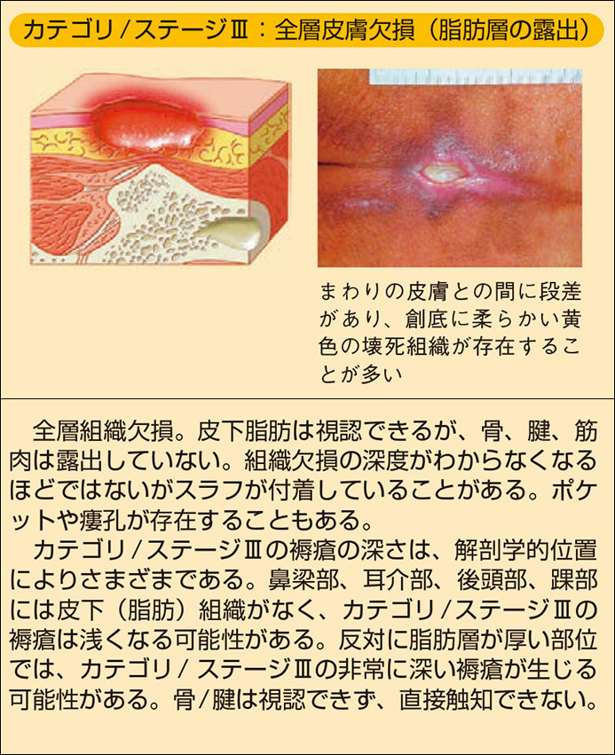 米国 褥瘡 諮問 委員 会 の 分類 で