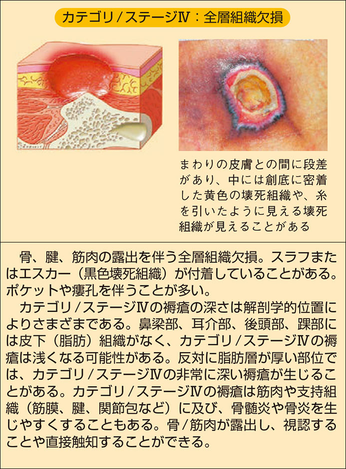 褥瘡 皮膚 の 乾燥