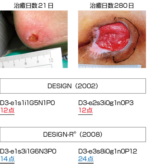 図１ DESIGNとDESIGN-R®による異なる褥瘡での点数の変化