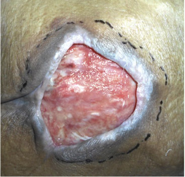 図２ 臨界的定着疑いの褥瘡