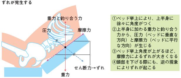 図１ 頭側挙上時に生じるせん断力