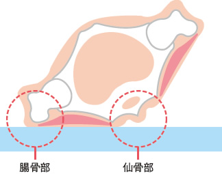 図３ やせが著明な場合の30 度側臥位での圧迫個所